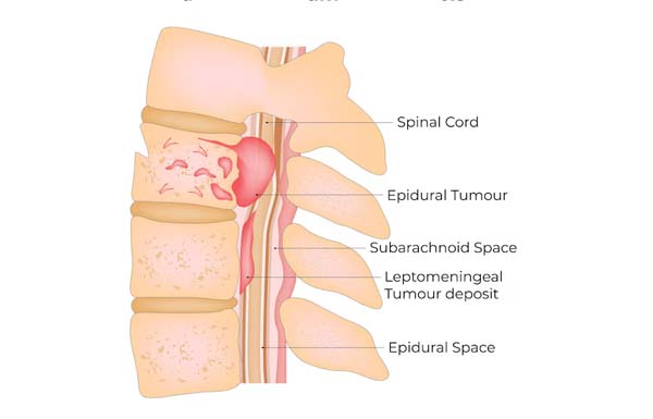 Spinal Tumor Surgery