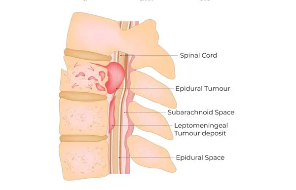 Spinal Tumor Surgery