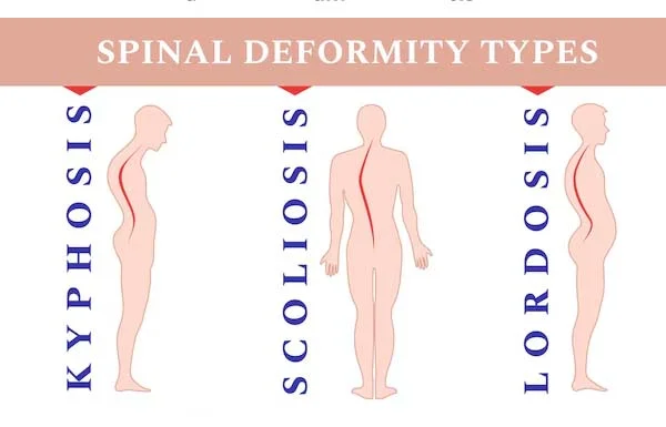 Deformity Correction Scoliosis and Kyphosis