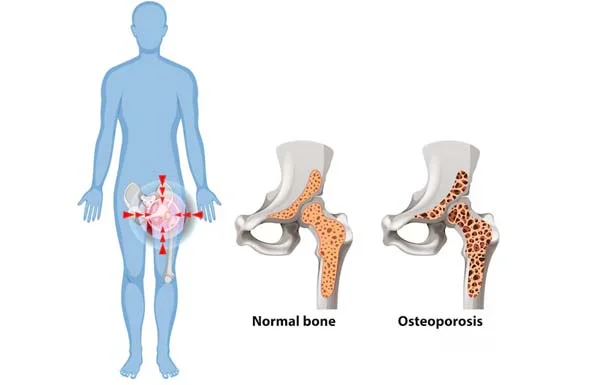 Osteoporosis