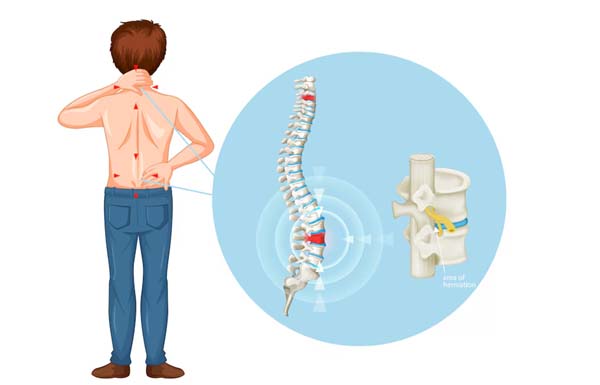 Slipped Disc